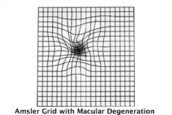 Amsler grid as it might appear to someone with age-related macular degeneration